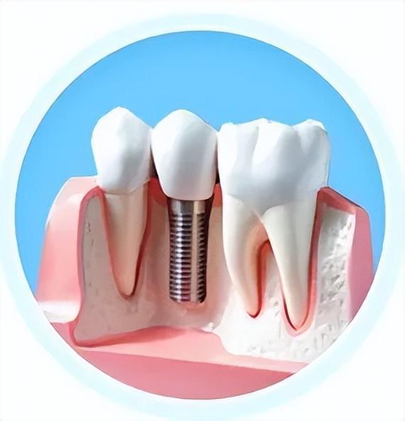 种植牙遭遇黄瓜片，一次牙冠碎裂的意外经历