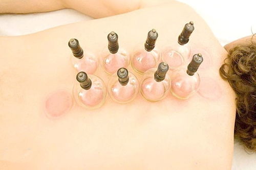 女生美容院拔罐后变身紫薯精的奇妙经历