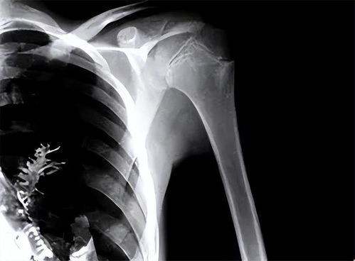 男子确诊肺癌医生一根针冻死癌细胞