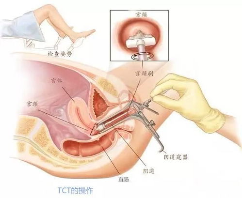 女子陪妹妹复查乳腺自己也查出癌症
