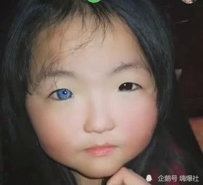 医生回应7岁女孩天生异瞳