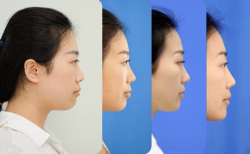 医生称森碟下巴后缩或影响口腔功能