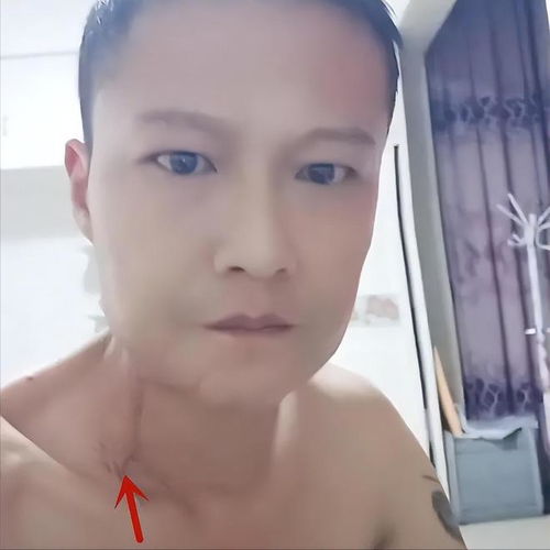 小伙嚼槟榔8年瓜子脸变方块脸 小伙嚼槟榔8年瓜子脸变方块脸